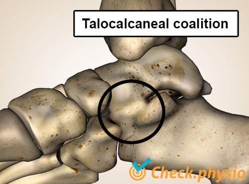 Fuss talocalcaneale Koalition