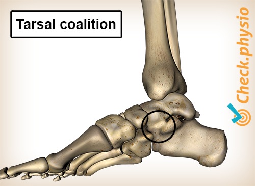 Fuss tarsale Koalition medial Innenseite