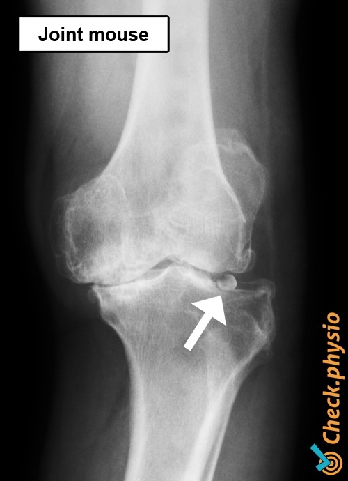 Corpus liberum Knie Röntgen