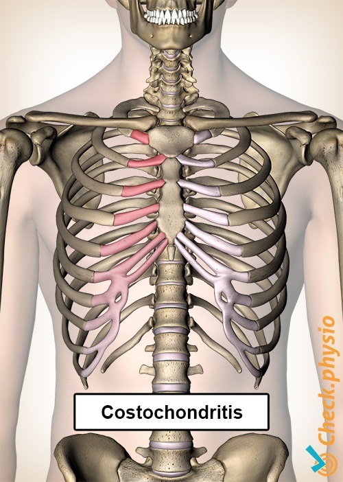 Costochondritis Rippen Schmerz Brust Brustbein