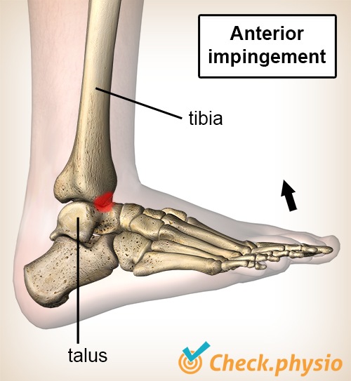 Knöchel vorderes Impingement dorsale Flexion