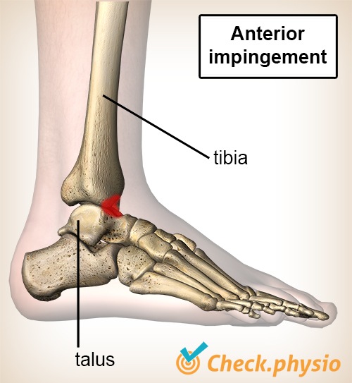 Knöchel vorderes Impingement