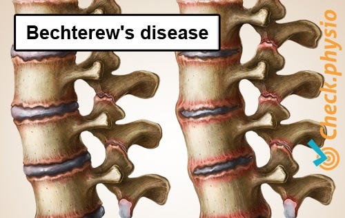 rückenspezifische tiefe Rückenschmerzen Morbus Bechterew ankylosierende Spondylitis