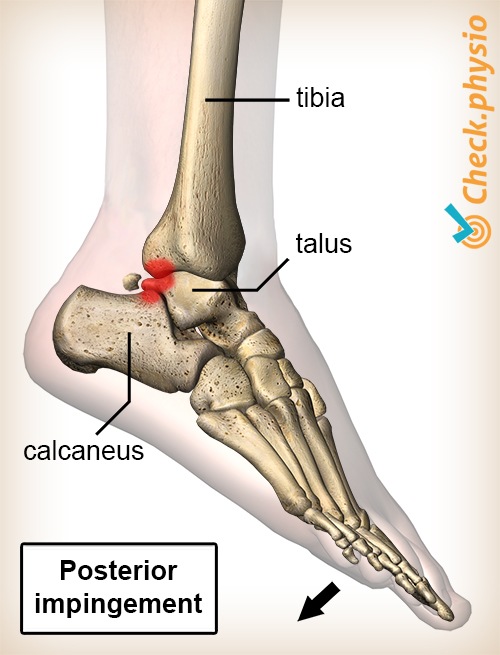 Knöchel posteriores Impingement Plantarflexion