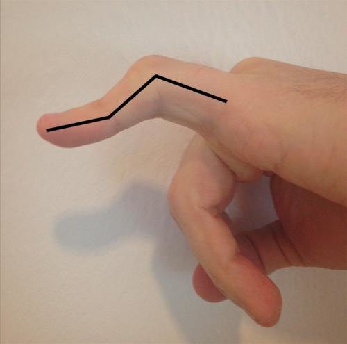 Hand Knopflochdeformität