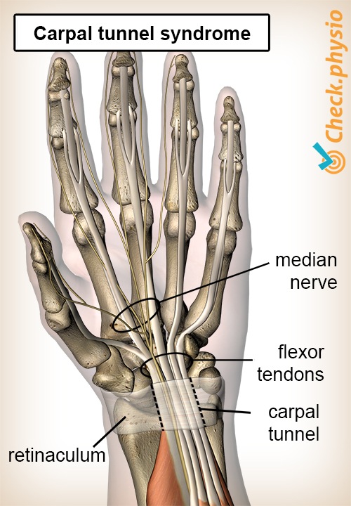 hand Karpaltunnelsyndrom Carpale Einklemmung