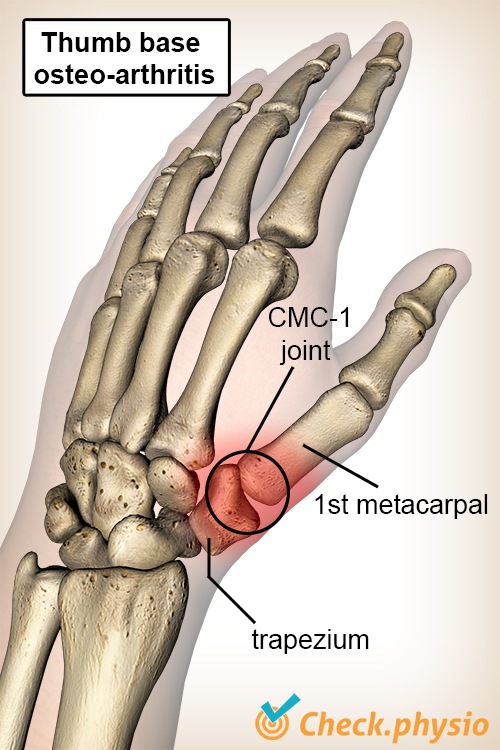 Hand Daumen Daumengrundgelenk Arthrose Os Trapezium Mittelhandknochen Metakarpal I CMC 1 Gelenk