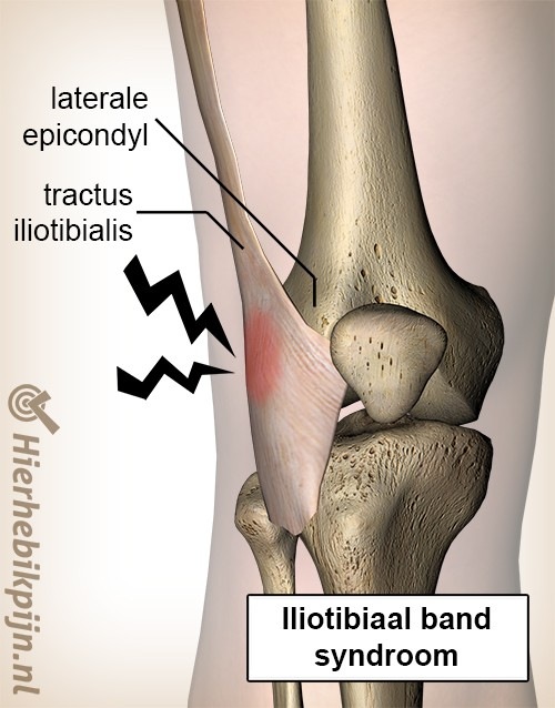 Knie Iliotibialband-Syndrom lateraler Epicondylus