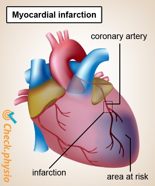 Herz Herzinfarkt Koronararterie Anatomie