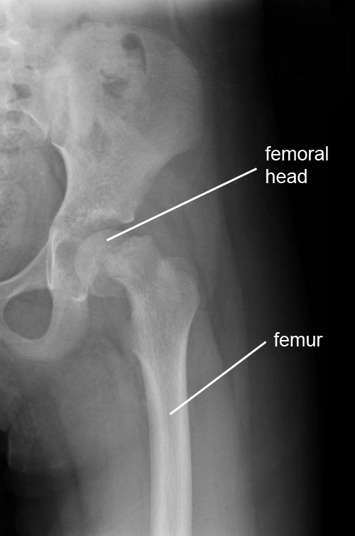 Hüfte Epiphysiolysis Capitis Femoris Röntgen