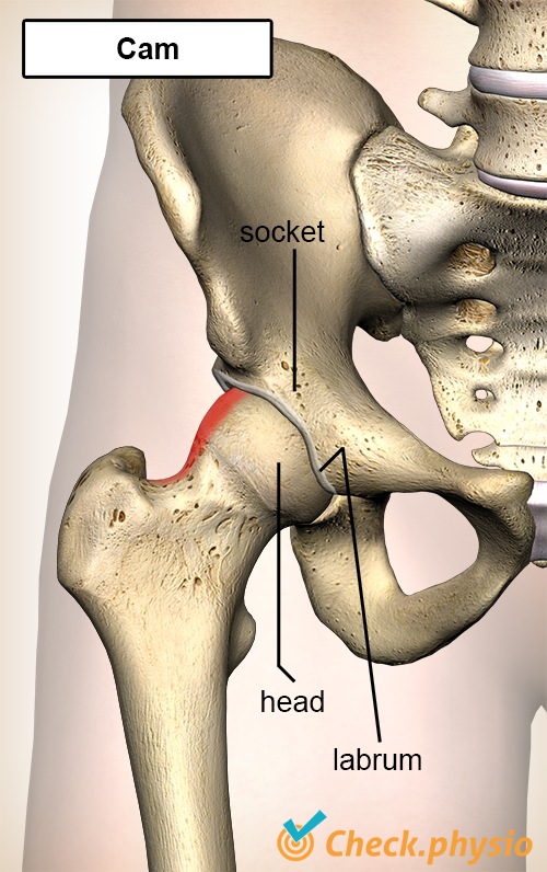 Hüfte femoroazetabuläres Impingement FAI Cam