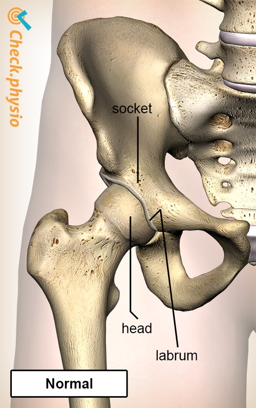 Hüfte femoroazetabuläres Impingement FAI normal