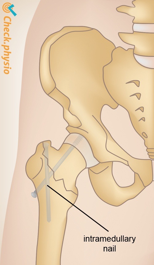 Hüfte Hüftfraktur Gamma-Nagel