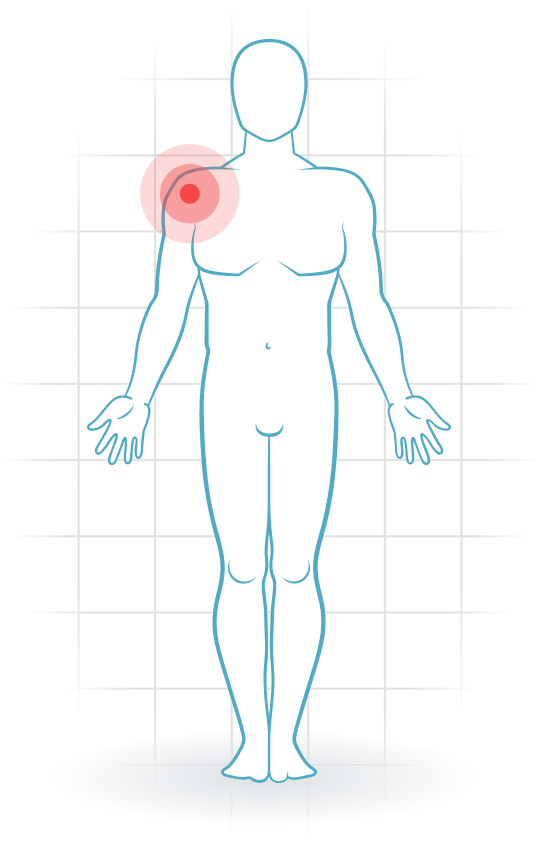 pijnlocatie Internes Impingement