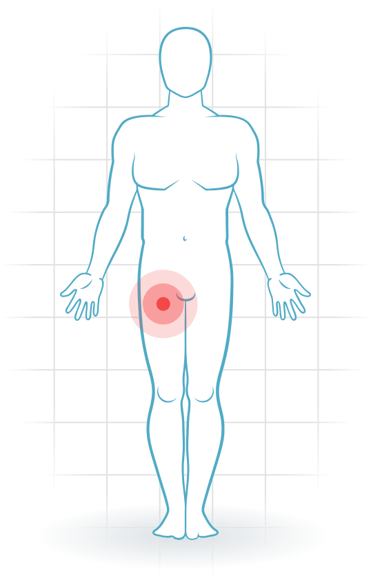 pijnlocatie Rectus-femoris-Tendinopathie