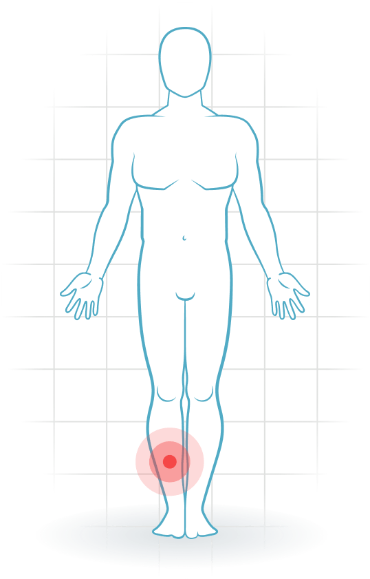 pijnlocatie Mediales Tibiales Stresssyndrom