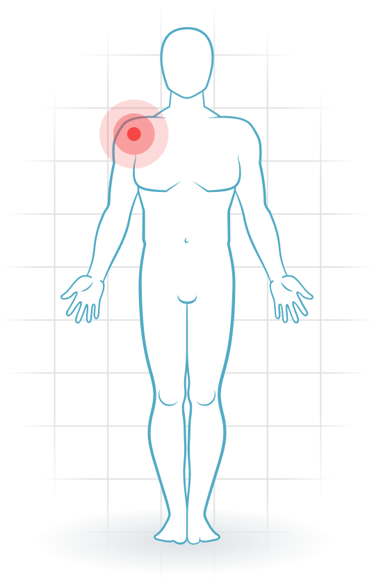pijnlocatie Schulterarthrose