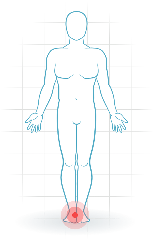 pijnlocatie Tarsaltunnelsyndrom