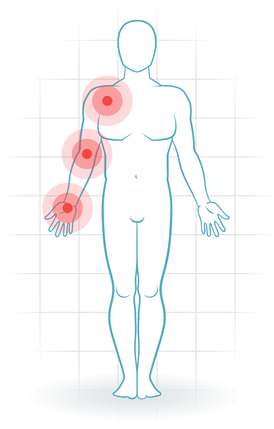 pijnlocatie Thoracic-outlet-Syndrom